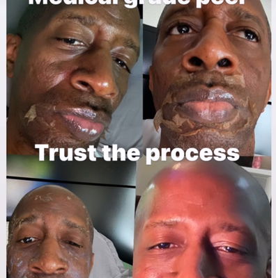 Vi Body Peel Kit (Small/Medium 4ML) -Authentic Exp. 02/2027